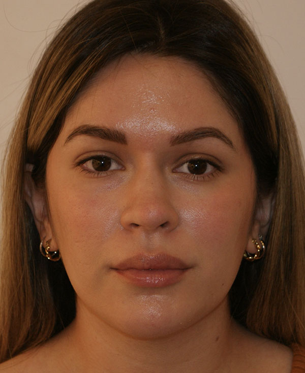 Photo of Patient 15 After Nose Procedure