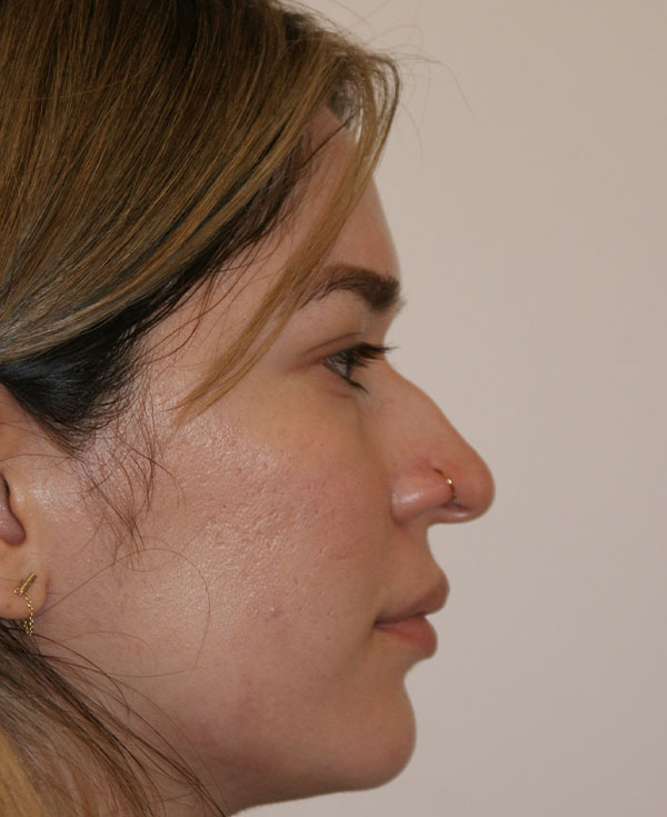 Photo of Patient 15 Before Nose Procedure