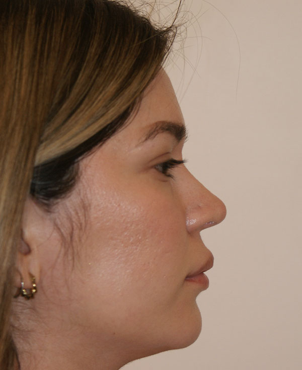 Photo of Patient 15 After Nose Procedure