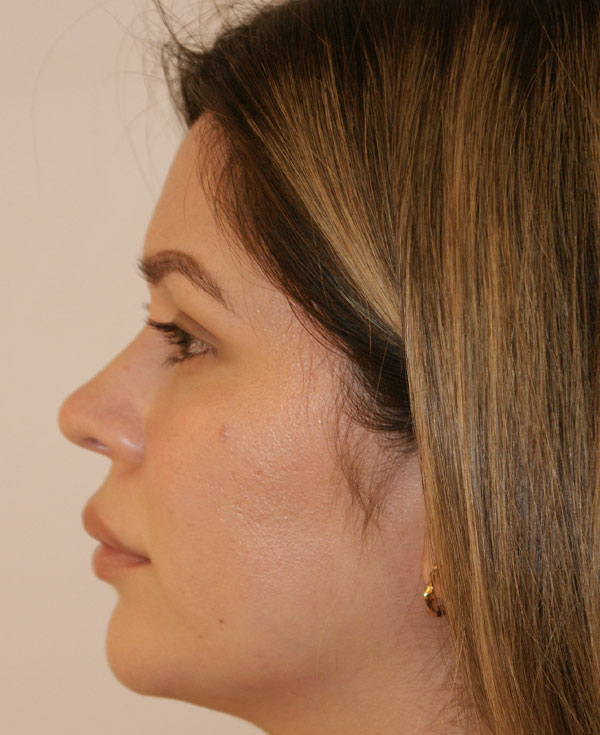 Photo of Patient 15 Before Nose Procedure