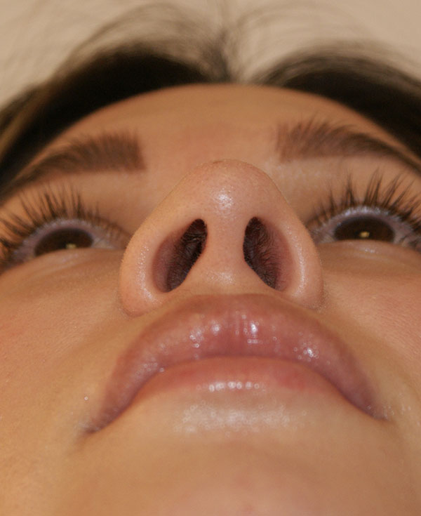 Photo of Patient 15 Before Nose Procedure