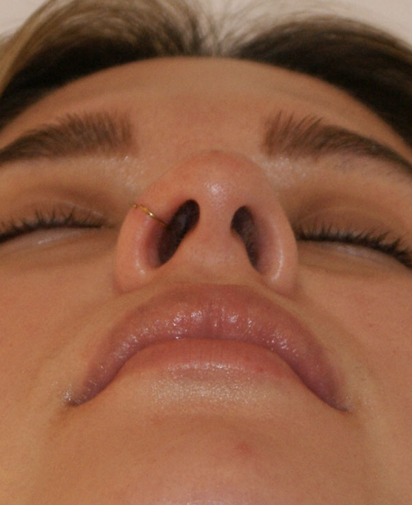 Photo of Patient 15 After Nose Procedure