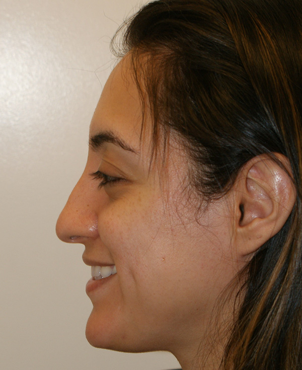 Photo of Patient 15 Before Nose Procedure