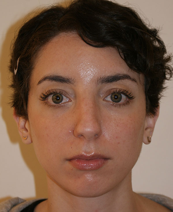 Photo of Patient 16 Before Nose Procedure