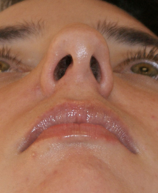 Photo of Patient 16 Before Nose Procedure