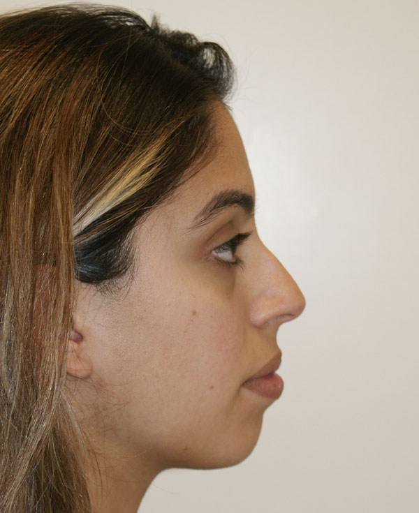 Photo of Patient 17 Before Nose Procedure