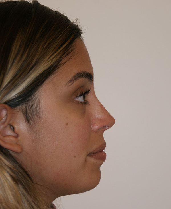 Photo of Patient 17 After Nose Procedure