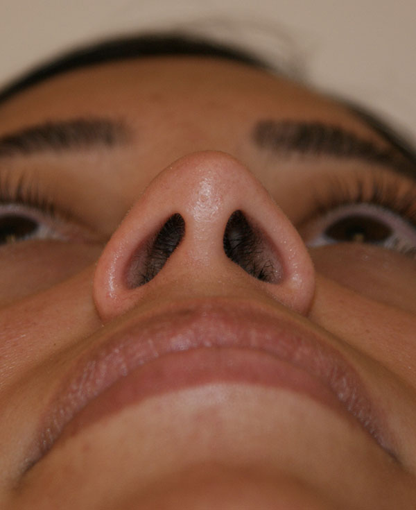 Photo of Patient 17 Before Nose Procedure