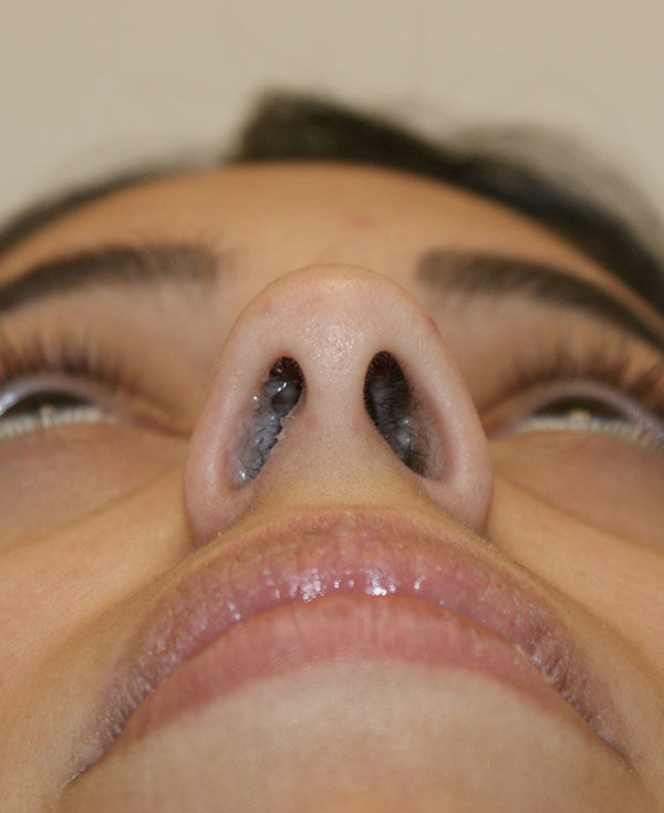 Photo of Patient 17 After Nose Procedure