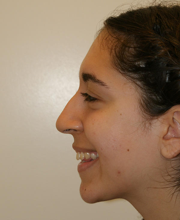 Photo of Patient 17 Before Nose Procedure