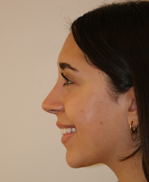 Photo of Patient 17 After Nose Procedure