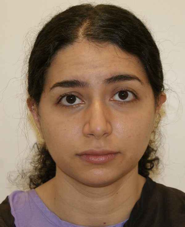 Photo of Patient 18 Before Nose Procedure