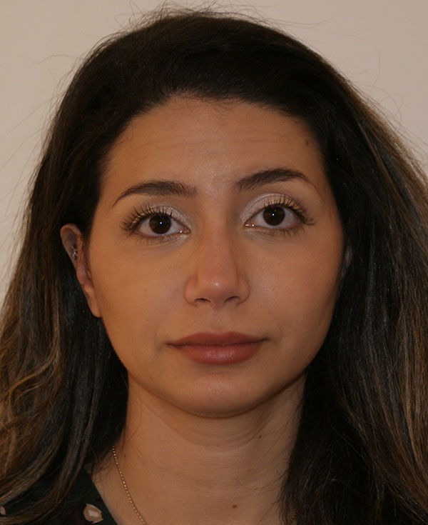 Photo of Patient 18 After Nose Procedure