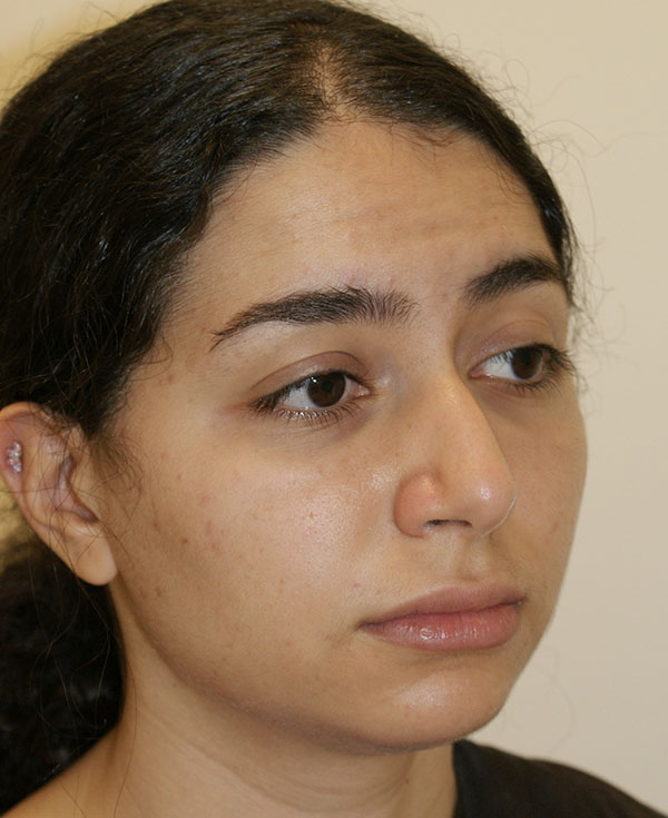 Photo of Patient 18 Before Nose Procedure