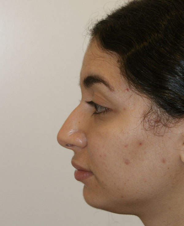 Photo of Patient 18 Before Nose Procedure