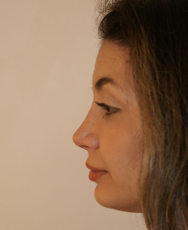 Photo of Patient 18 After Nose Procedure