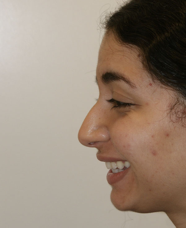 Photo of Patient 18 Before Nose Procedure