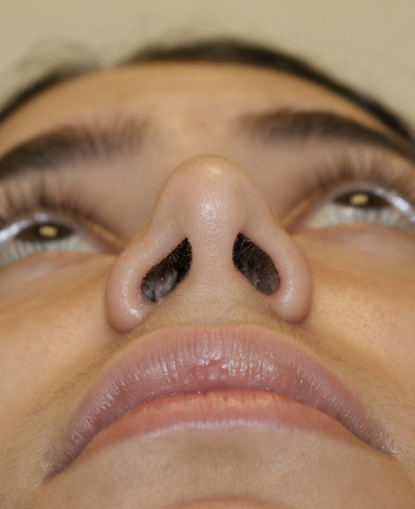 Photo of Patient 18 Before Nose Procedure