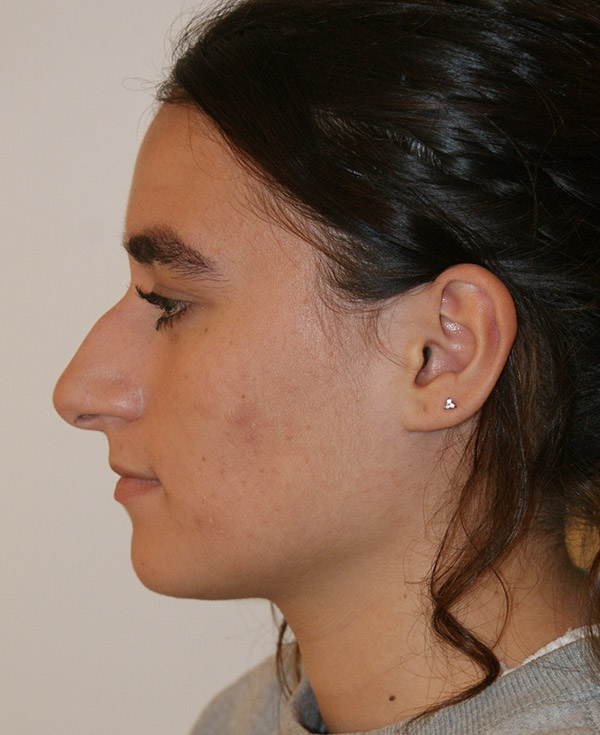 Photo of Patient 19 Before Nose Procedure