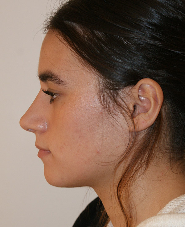 Photo of Patient 19 After Nose Procedure