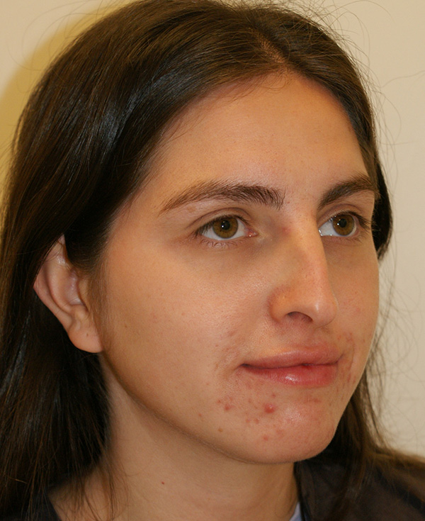 Photo of Patient 19 Before Nose Procedure