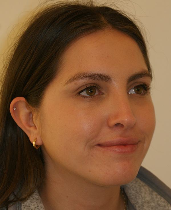 Photo of Patient 19 After Nose Procedure