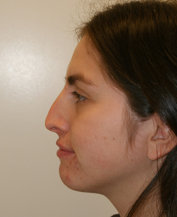 Photo of Patient 19 Before Nose Procedure