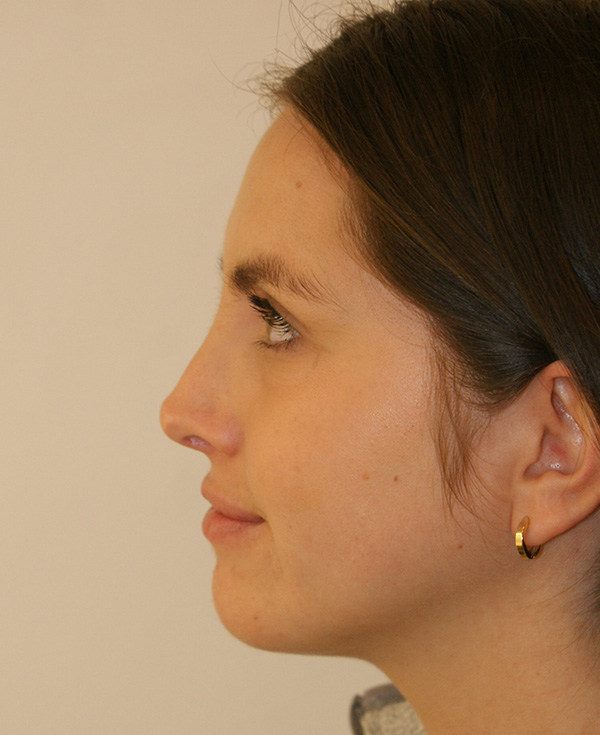 Photo of Patient 19 After Nose Procedure