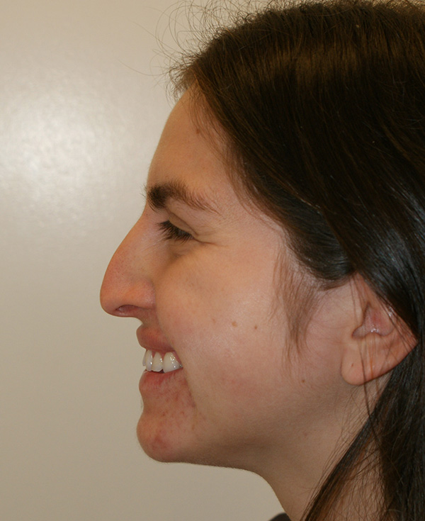 Photo of Patient 19 Before Nose Procedure
