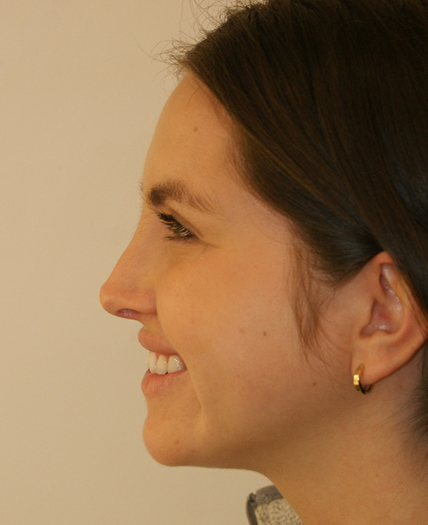 Photo of Patient 19 After Nose Procedure