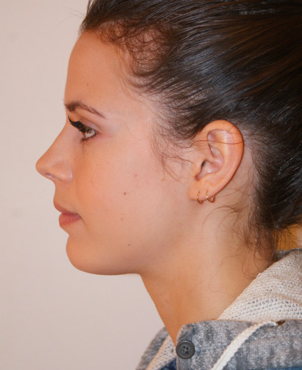 Photo of Patient 20 After Nose Procedure