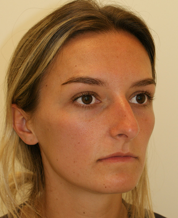 Photo of Patient 20 Before Nose Procedure