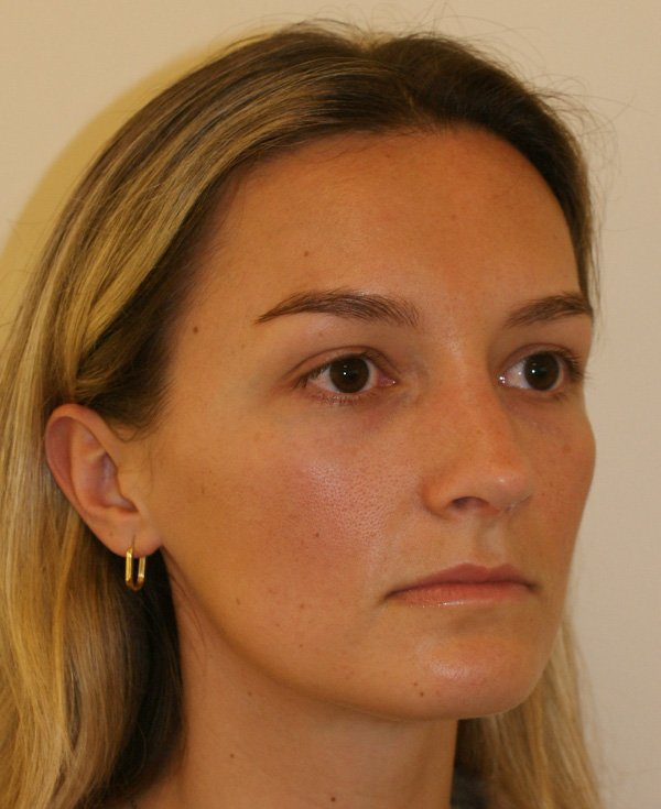 Photo of Patient 20 After Nose Procedure