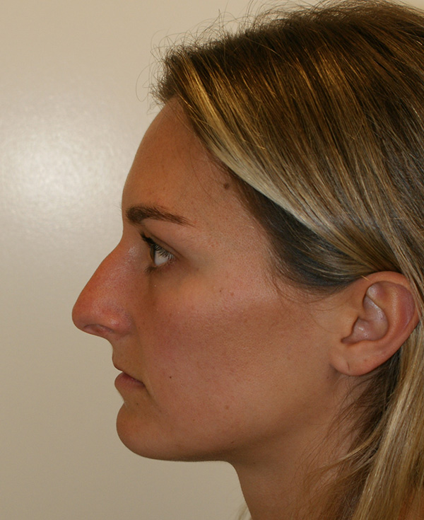 Photo of Patient 20 Before Nose Procedure
