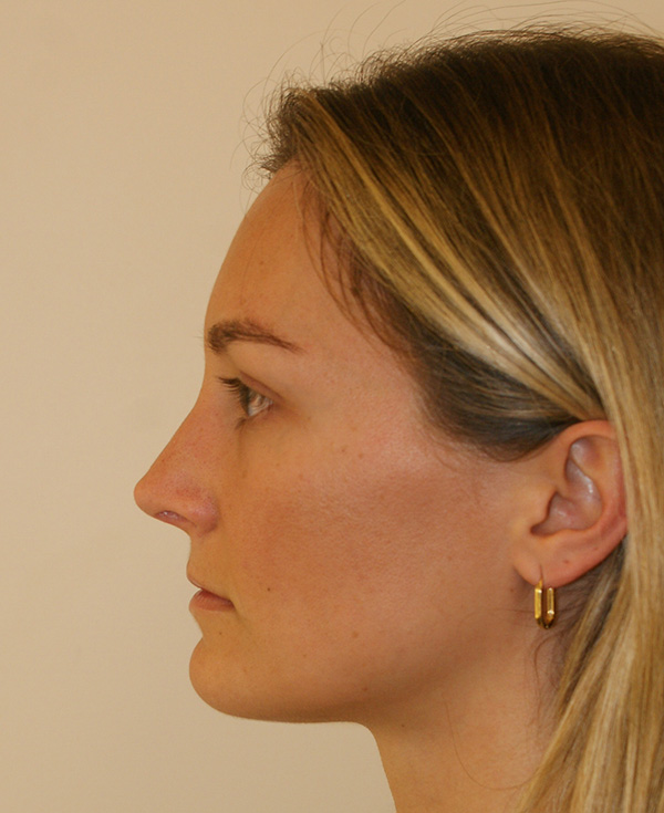 Photo of Patient 20 After Nose Procedure