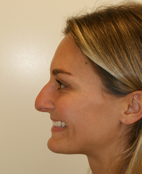 Photo of Patient 20 Before Nose Procedure