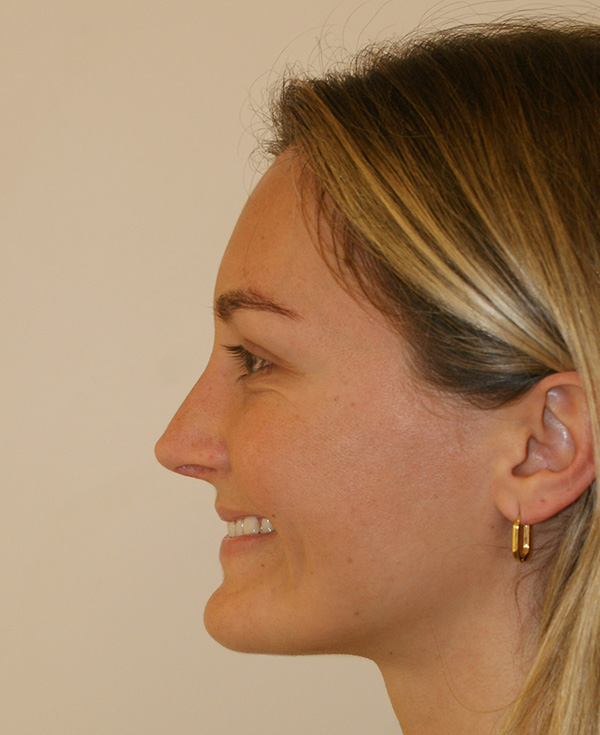 Photo of Patient 20 After Nose Procedure