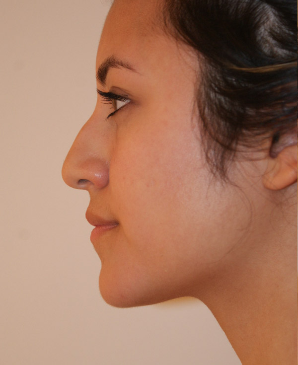 Photo of Patient 21 Before Nose Procedure