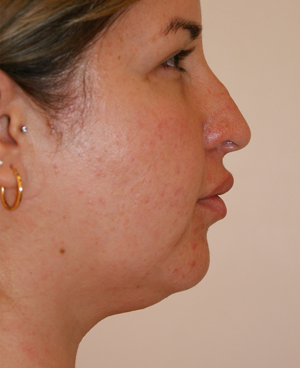 Photo of Patient 21 Before Nose Procedure