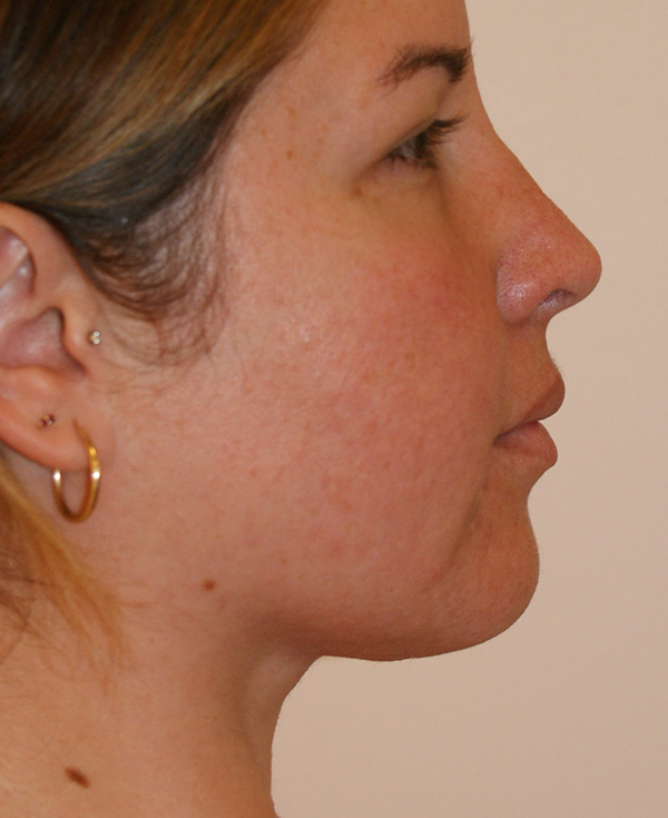 Photo of Patient 21 After Nose Procedure