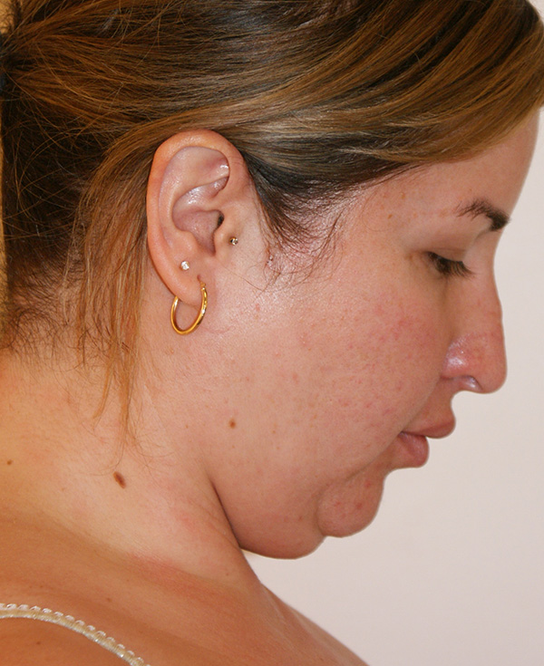 Photo of Patient 21 Before Nose Procedure