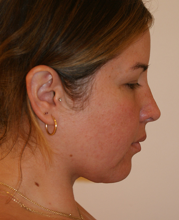 Photo of Patient 21 After Nose Procedure