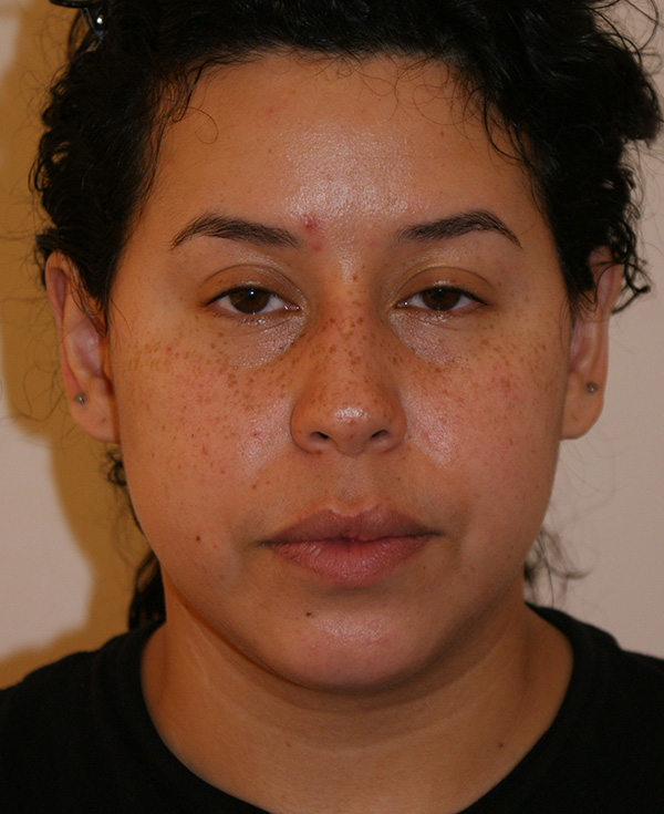 Nose Before and After | Dino Elyassnia, MD