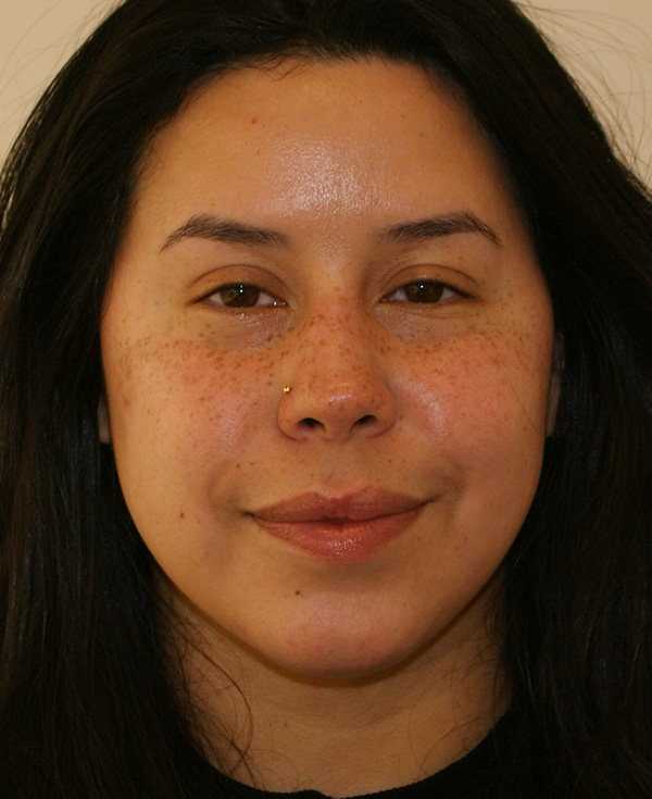 Nose Before and After | Dino Elyassnia, MD