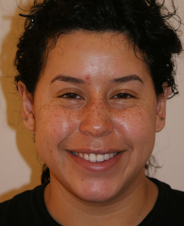 Photo of Patient 22 Before Nose Procedure