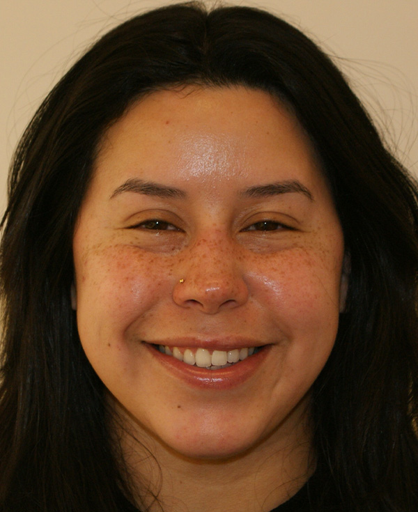 Photo of Patient 22 After Nose Procedure