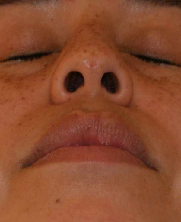Photo of Patient 22 Before Nose Procedure