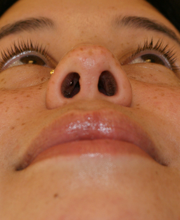 Photo of Patient 22 After Nose Procedure