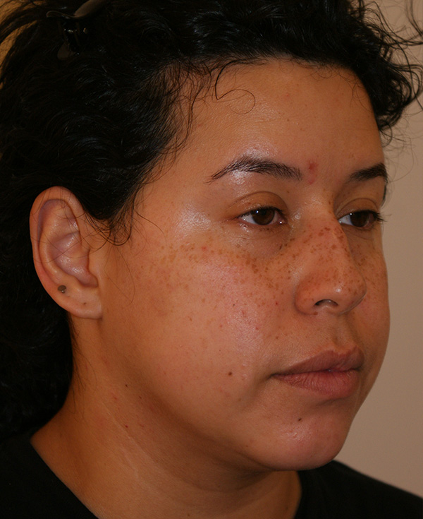 Photo of Patient 22 Before Nose Procedure
