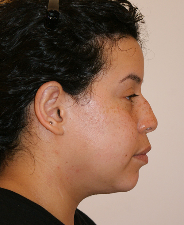 Photo of Patient 22 Before Nose Procedure